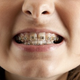 Illustration for article titled My Nine Years Of Orthodontic Torture
